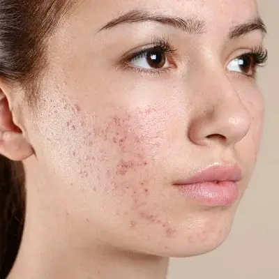 photo of a woman with acne seeking treatment from a pharmacist