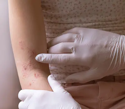 a close up of a persons arm with eczema or a rash being examined by a pharmacist.
