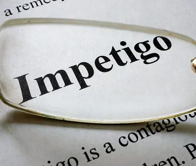 photo of the word impetigo framed by glasses lens