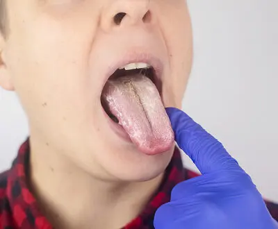 a photo of a person's tong looking for treatment for oral thrush from a pharmacist