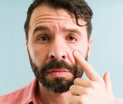 A photo of a man in discomfort because of pink eye infection seeking antibiotics from a pharmacist.