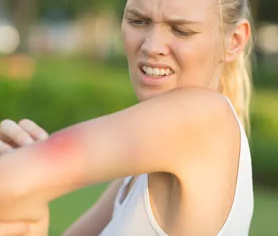 photo of a woman recently bitten by a tick