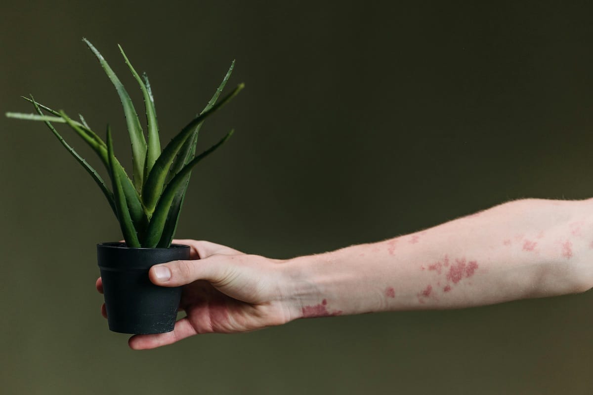 Photo of a person in Orleans Ontario with eczema or a skin rash holding a potted aloe